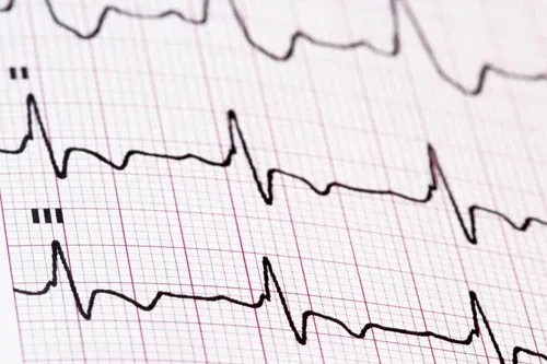EKG-Diagnostik